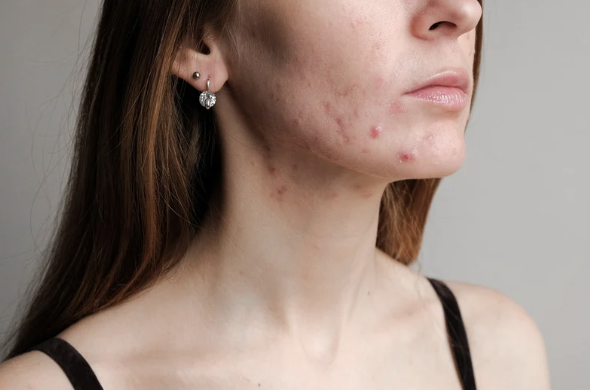 Hormonal Acne: Why are you still breakout out after puberty?